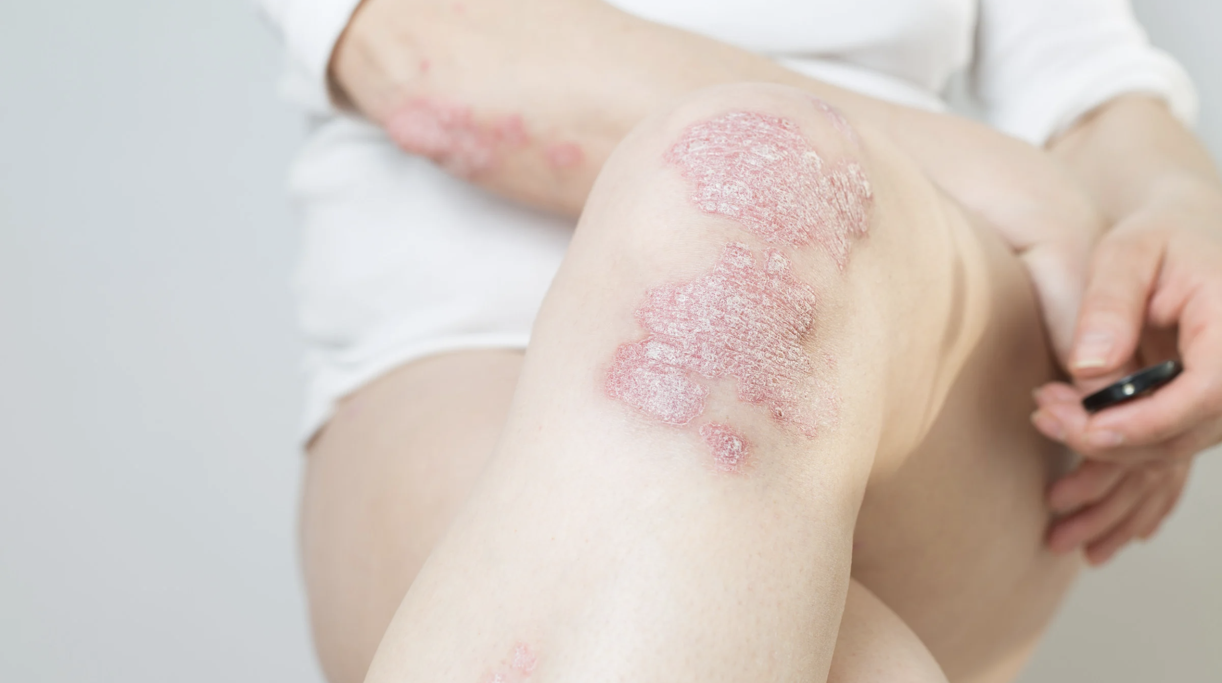 Psoriasis On Knees